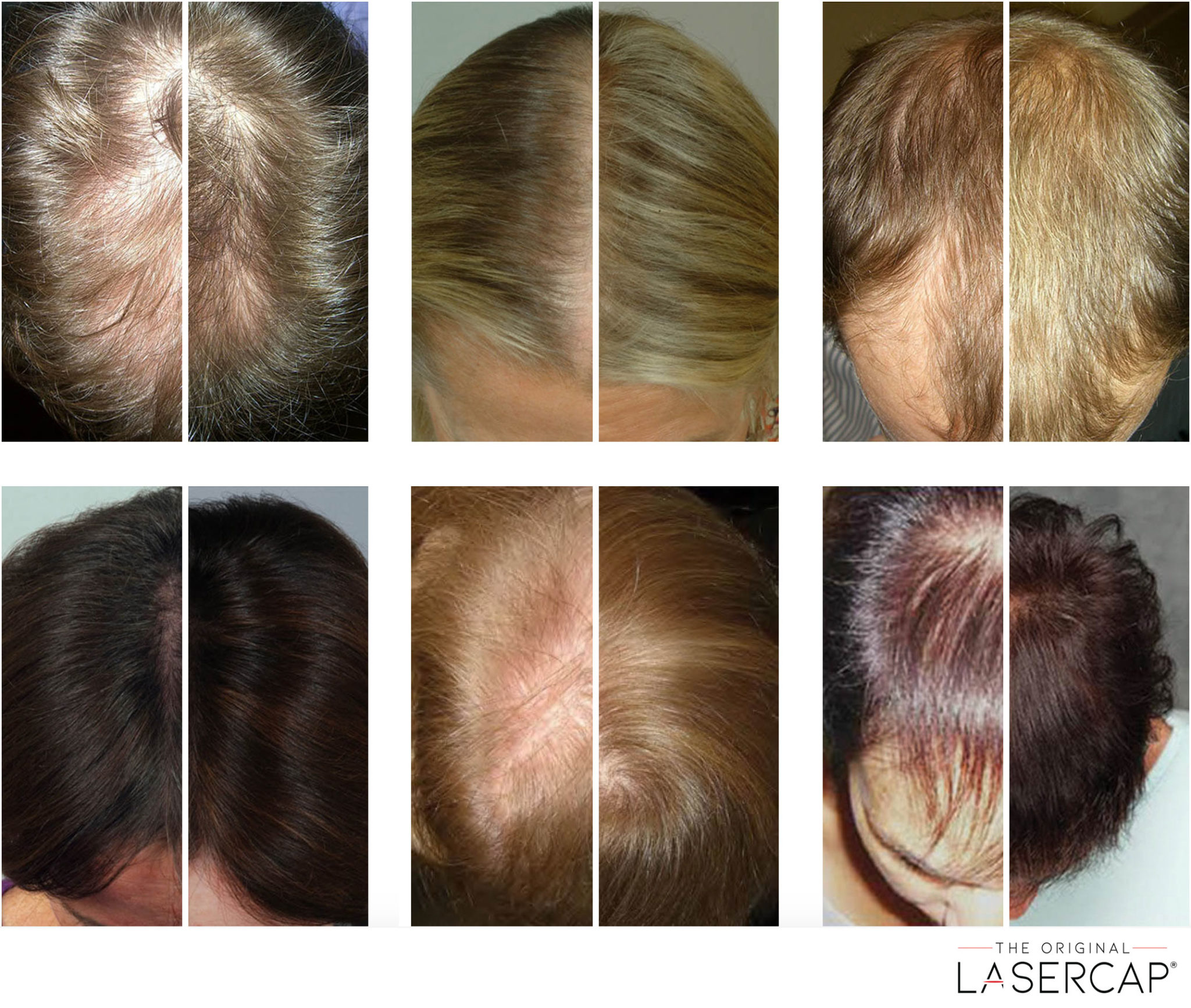 LaserCap Before & After Clients