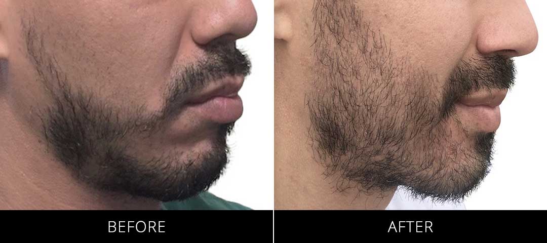 Beard Restoration Before & After