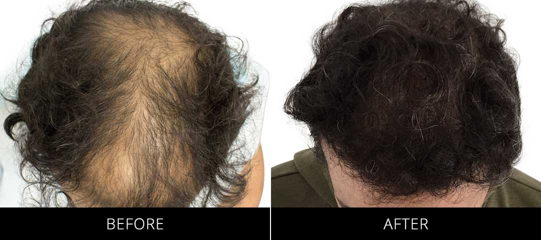 Hair Restoration Before & After
