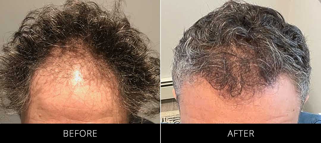 Hair Restoration Before & After