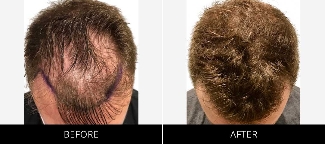 Hair Restoration Before & After