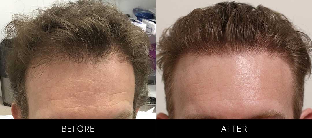 Hair Restoration Before & After
