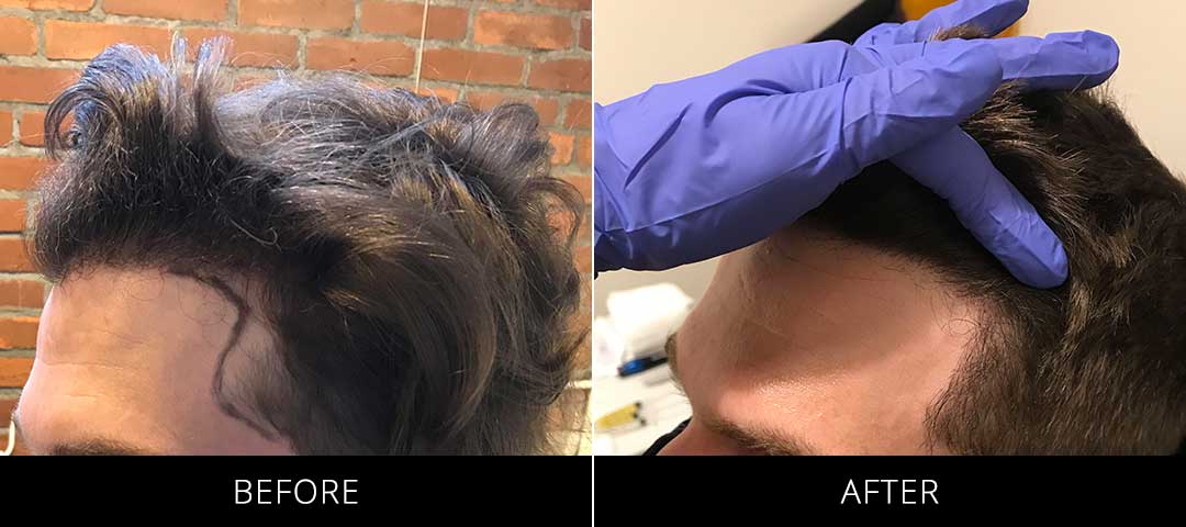 Hair Restoration Before & After