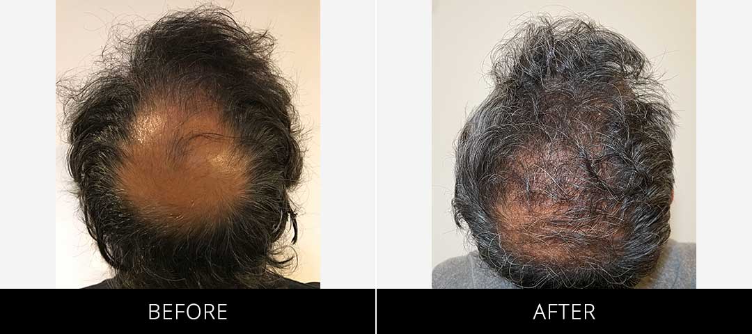 Hair Restoration Before & After
