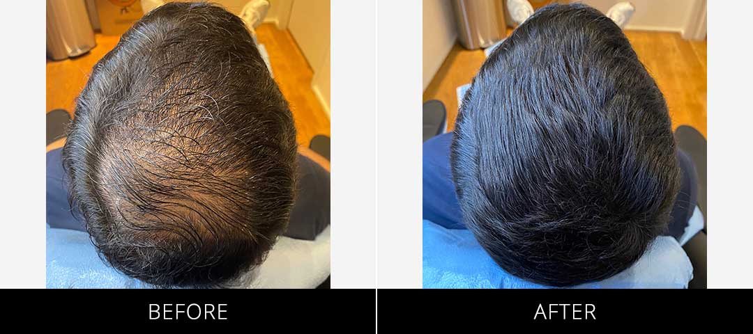 Scalp Camo Before & After