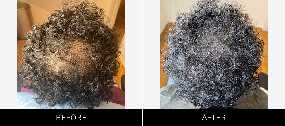 Scalp Camo Before & After