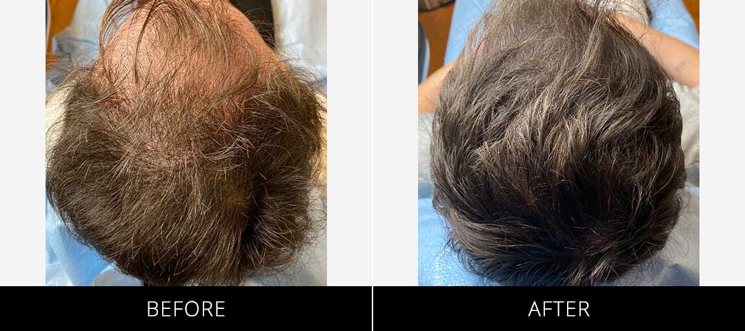 Scalp Camo Before & After