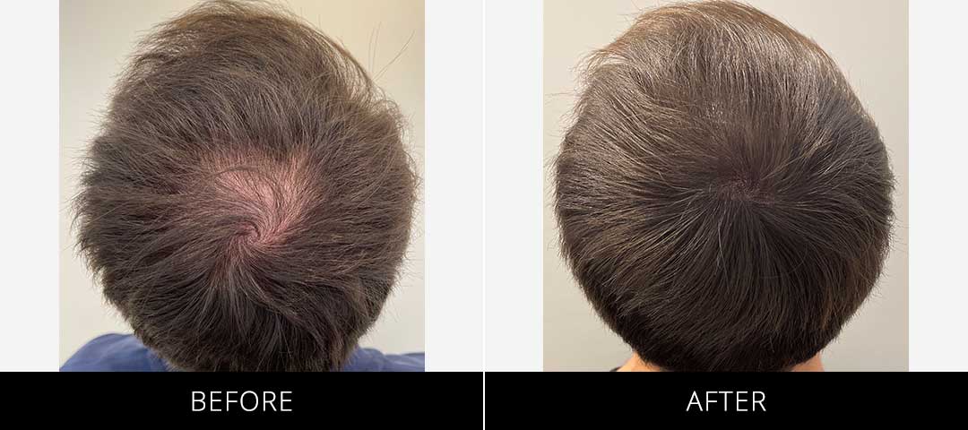 Scalp Camo Before & After