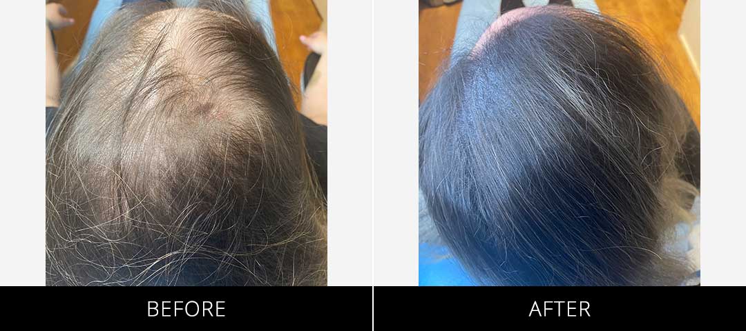Scalp Camo Before & After