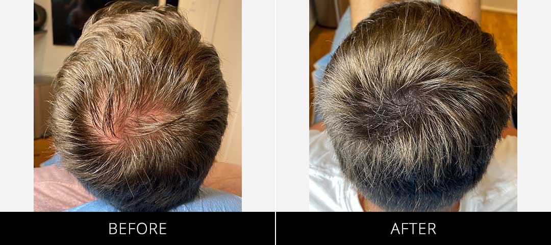 Scalp Camo Before & After
