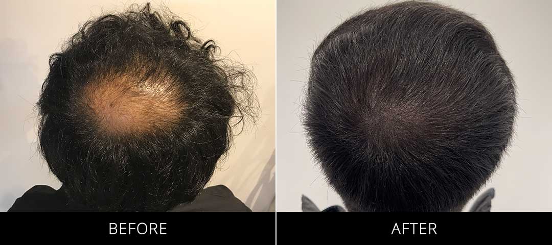 Scalp Camo Before & After