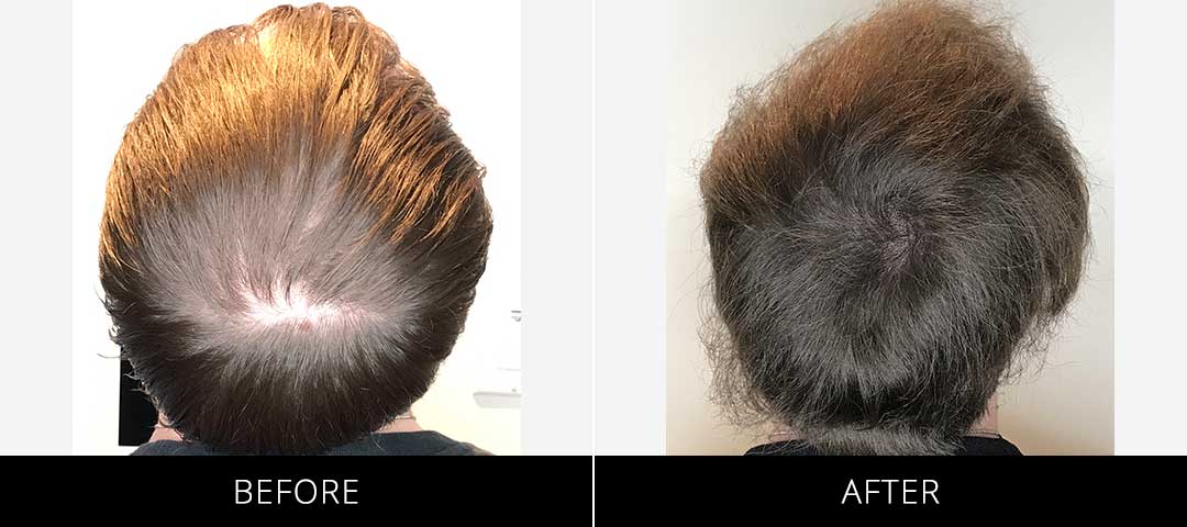 Scalp Camo Before & After