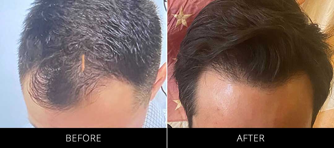 Hair Restoration Before & After Front