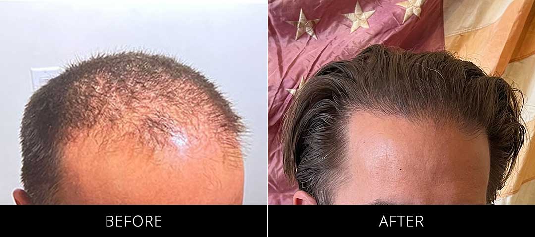 Hair Restoration Before & After Front