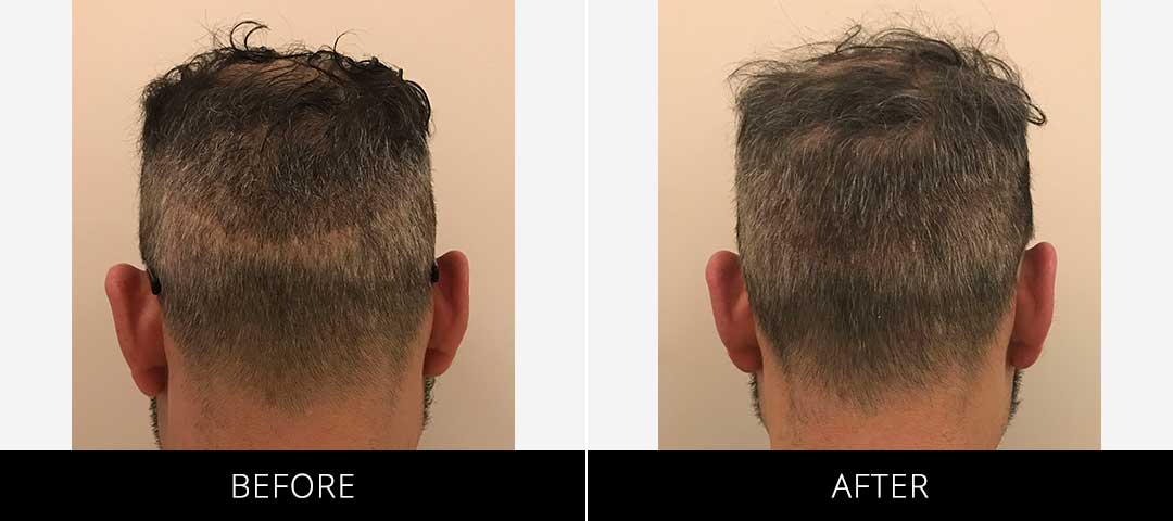 Scalp Camo Before & After