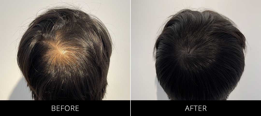 Scalp Camo Before & After