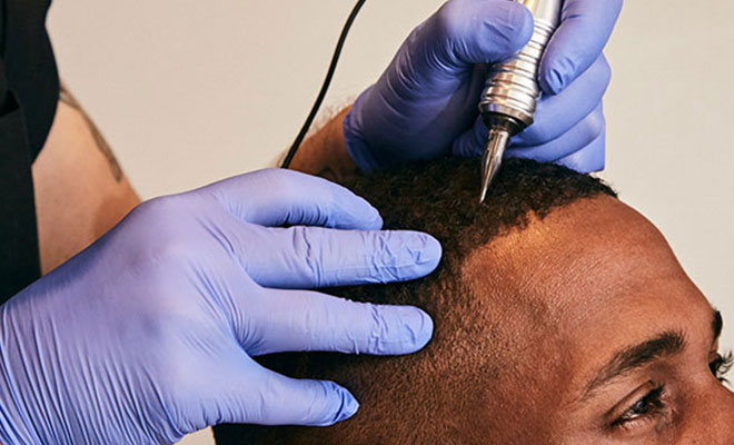 Scalp Camo Consultation