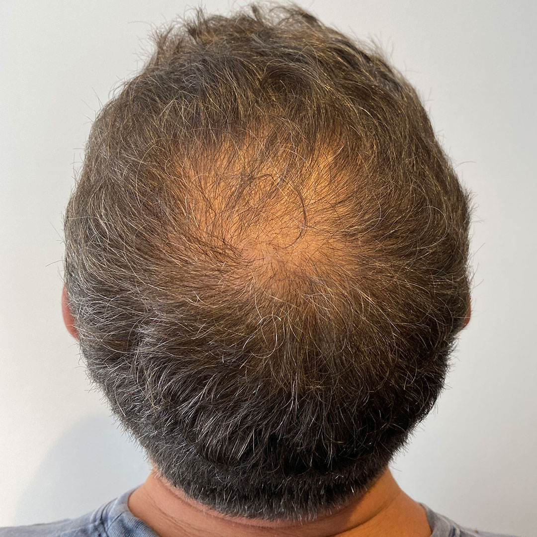 Hair Thinning